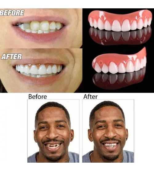 طقم أسنان علوي Perfect Smile قابل للإزالة - الصورة 3
